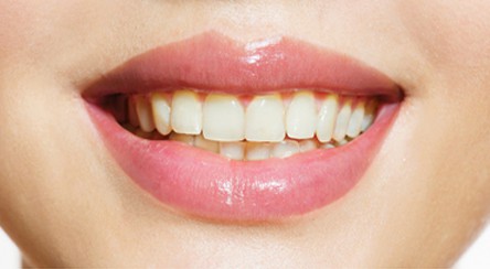 Ask us about whitening services