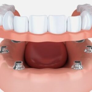 https://bahadds.com/wp-content/uploads/2023/06/implant-supported-dentures-300x300.jpg
