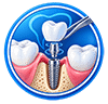 Dental implant placement icon
